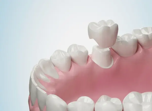 dental crowns for kids in nashville