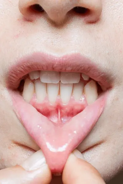 lip tie treatment for infants in nashville