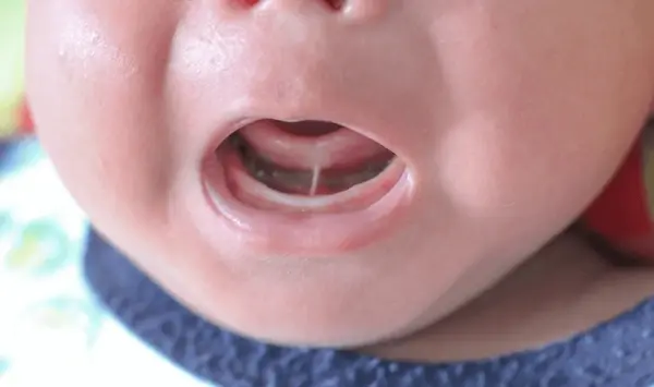 tongue tie treatment for infants near you