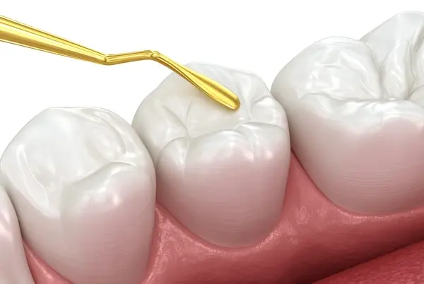 tooth colored fillings for children near you